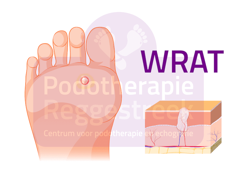 Wratten Voet Podotherapie Reggestreek Rijssen Wratten Voet Podotherapie Reggestreek Rijssen