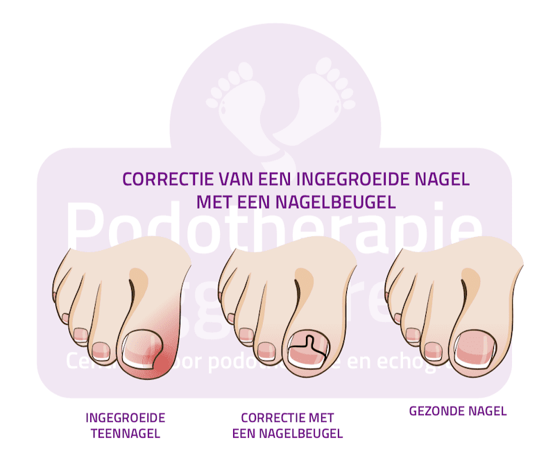 Nagelbeugel Ingegroeide Teennagel Podotherapie Reggestreek Rijssen Nagelbeugel Ingegroeide Teennagel Podotherapie Reggestreek Rijssen