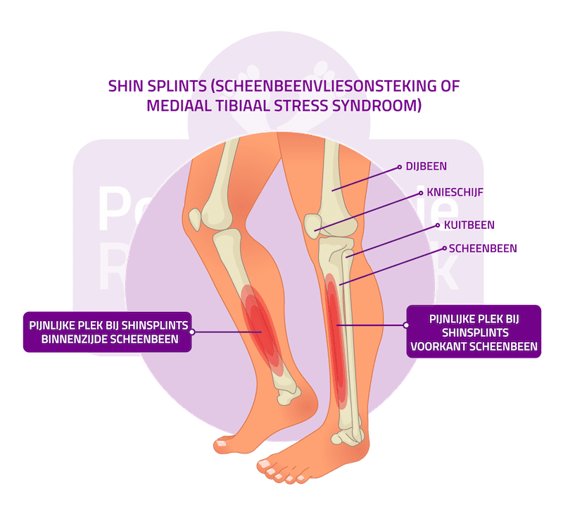 Shin Splints Springschenen Podotherapie Reggestreek Rijssen Shin Splints Springschenen Podotherapie Reggestreek Rijssen